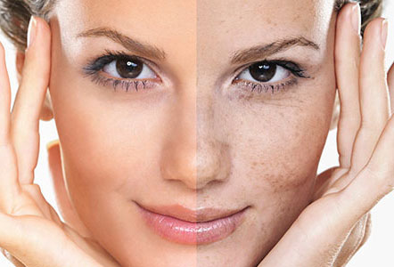مزایای اسید تراپی پوست صورت در رفع لکه ها و روشن و یکدست شدن رنگ پوست