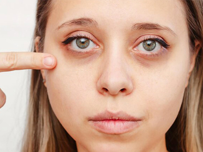 روش‌های درمان تیرگی دور چشم/گودی زیر چشم/چروک دور چشم