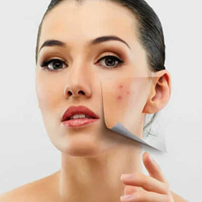 دوره آموزش اسید تراپی پوست|روش درمان لک صورت